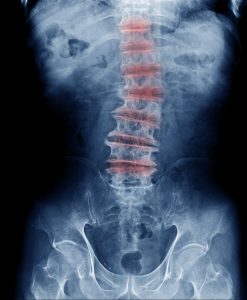 Degenerative disc disease 
