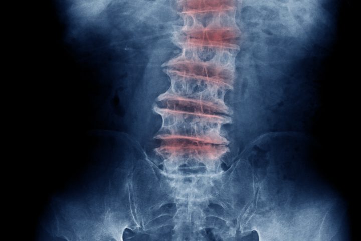 Degenerative disc disease